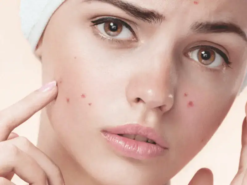 acne-spot-laser-treatment-prices