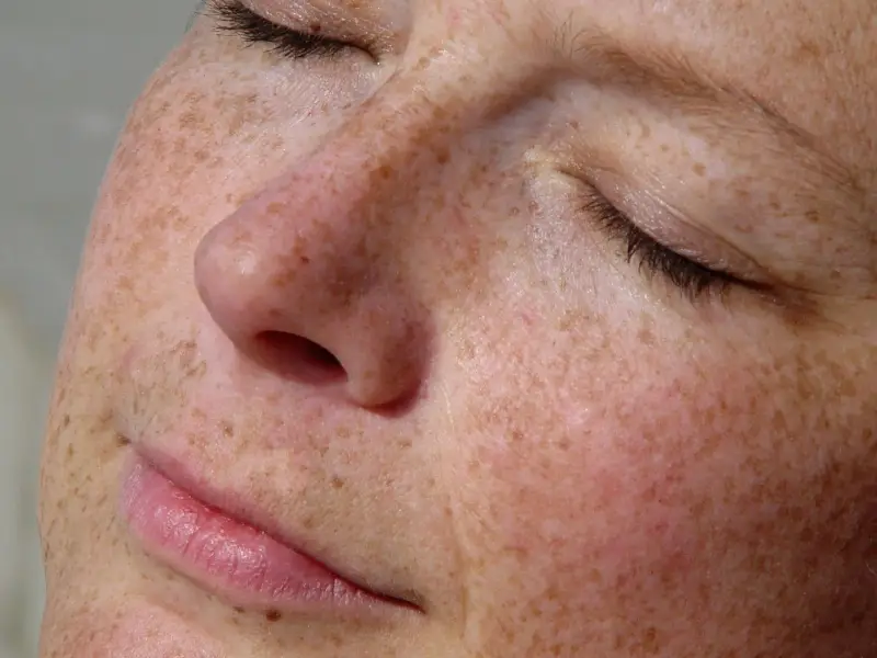 age-spots