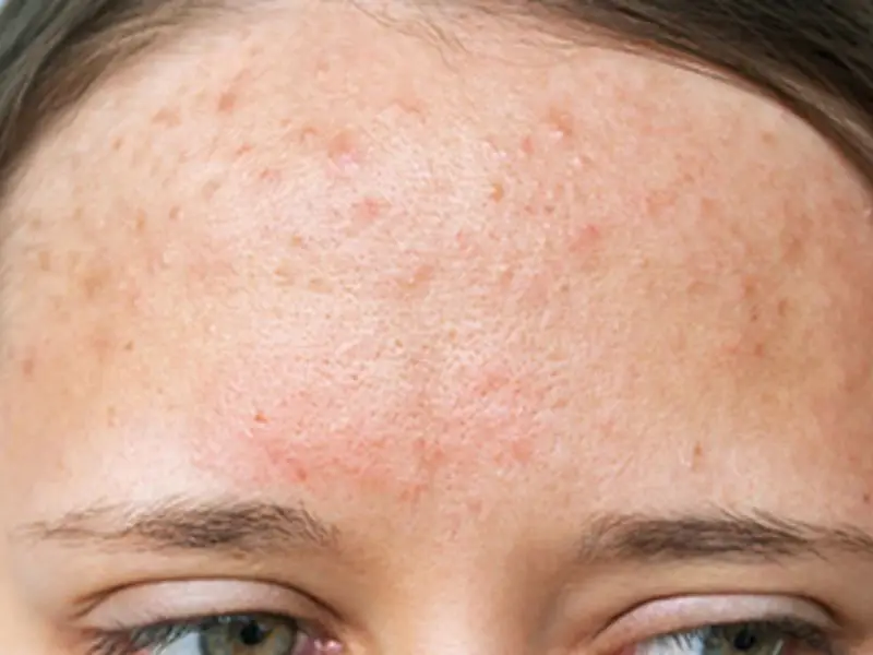 how-do-forehead-acne-scars-fade