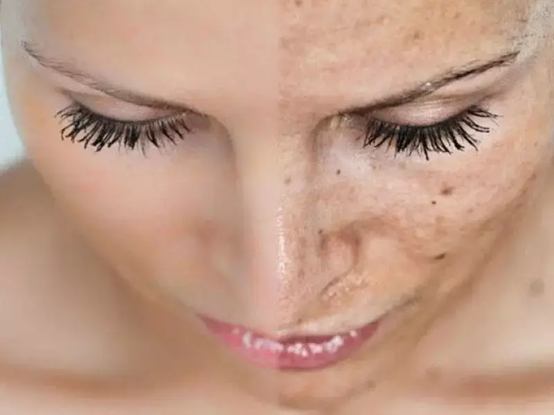 balikesir-melasma-treatment