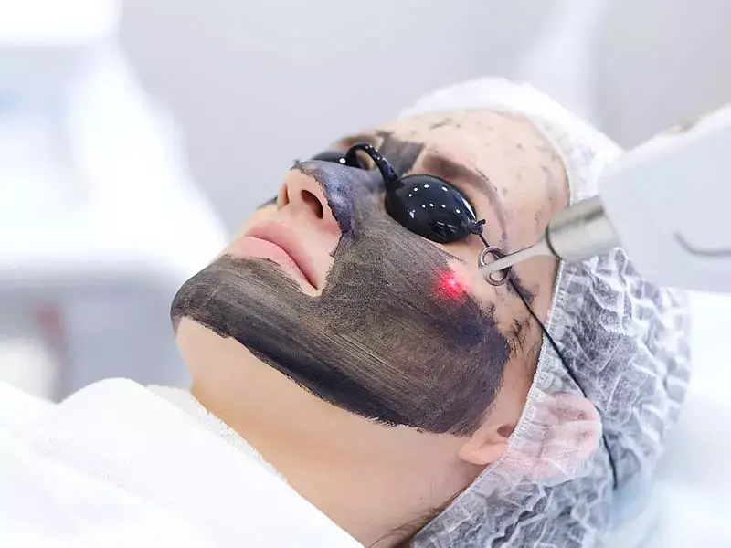 bilecik-karbon-peeling