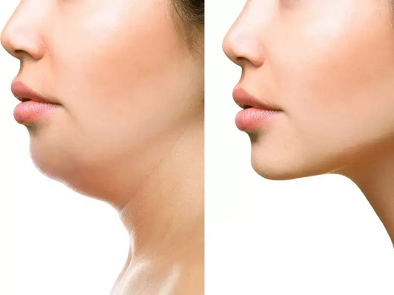 bursa-double-chin-meltdown-treatment
