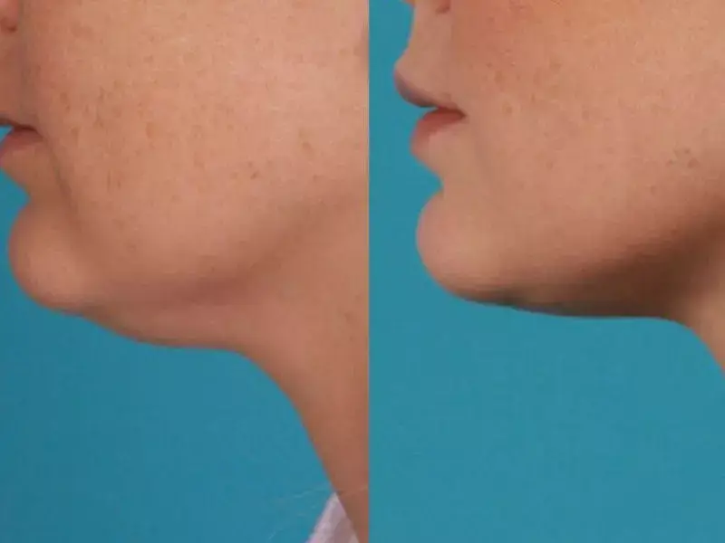 bursa-double-chin-removal