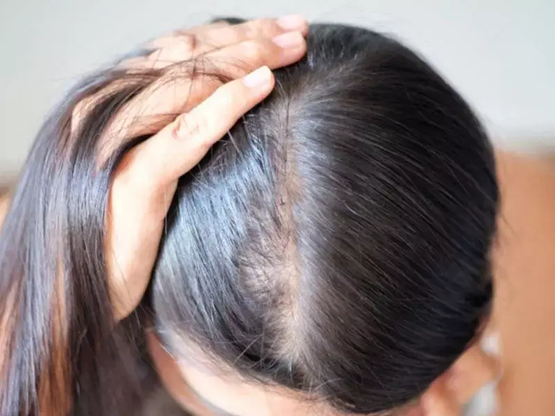 bursa-hair-revitalization-mesotherapy