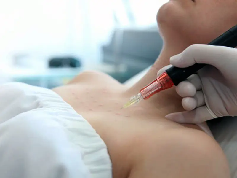 Decollete Mesotherapys