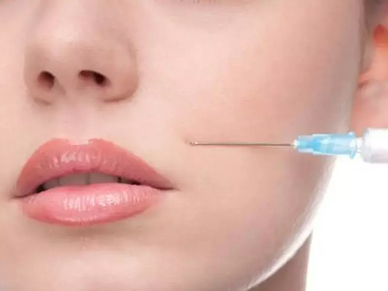 eskisehir-smile-line-filler