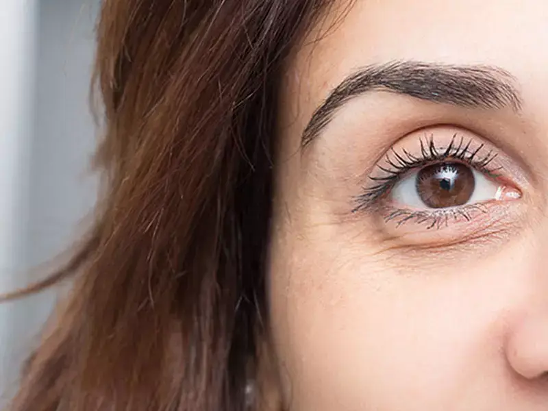 eskisehir-under-eye-dark-circle-mesotherapy