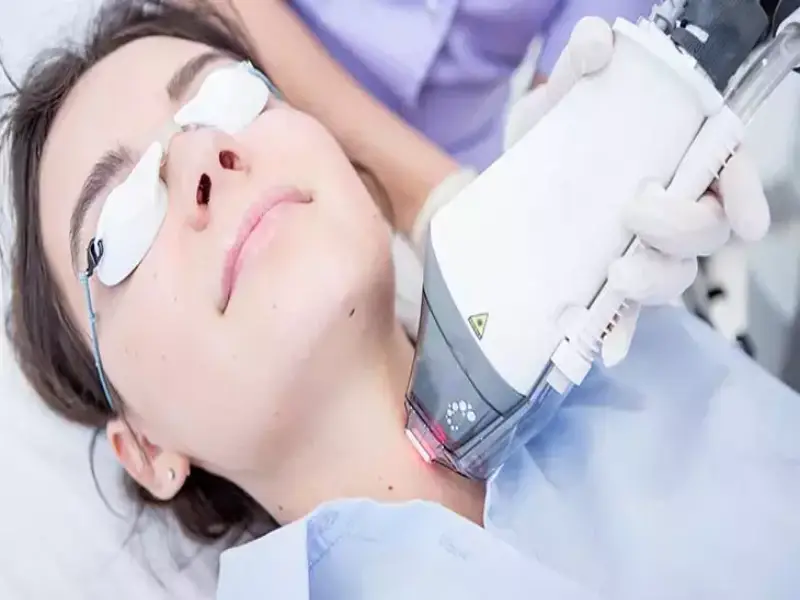 fractional-laser-experiences-price