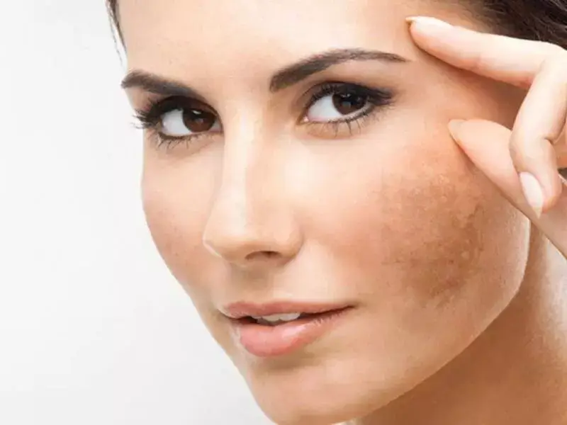 how-does-melasma-fade