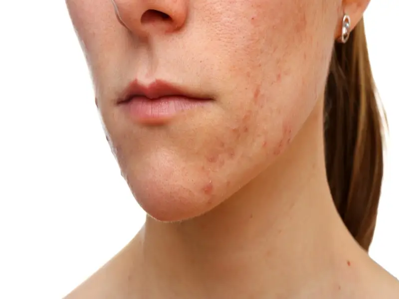 how-to-get-rid-of-acne-scars