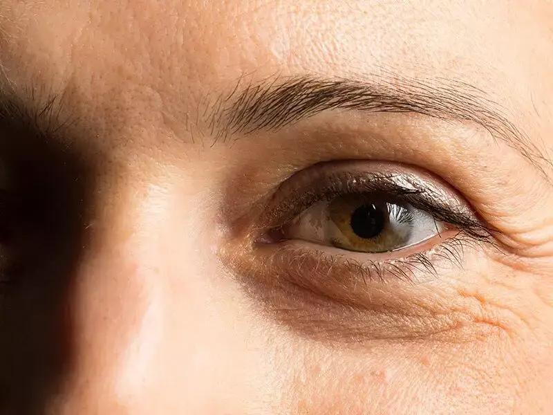 what-are-crow-s-feet-wrinkles