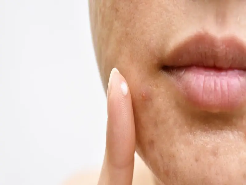 which-doctor-should-you-visit-for-acne