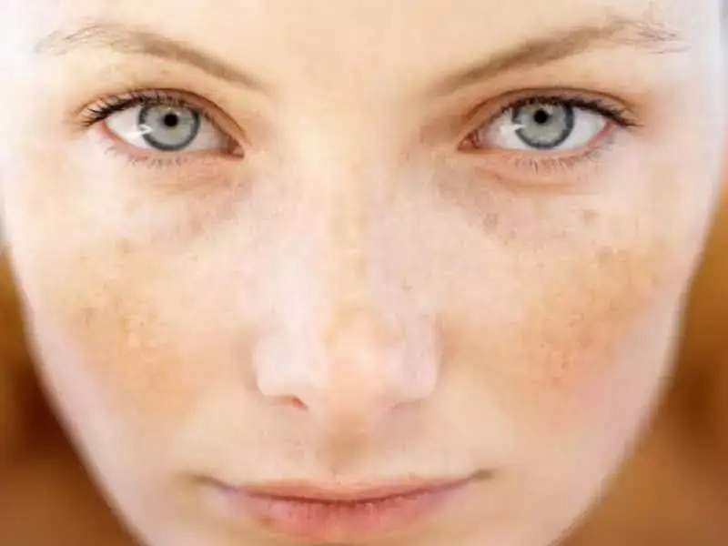 laser-treatment-for-facial-pigmentation